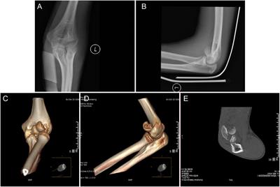 Good outcomes of elbow arthroscopy-assisted absorbable screw fixation for capitellum fracture of the humerus in children: a case series